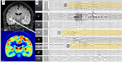 Case Report: Stereoelectroencephalography and Stereoelectroencephalography-Guided Radiofrequency Thermocoagulation in Familial Lateral Temporal Lobe Epilepsy